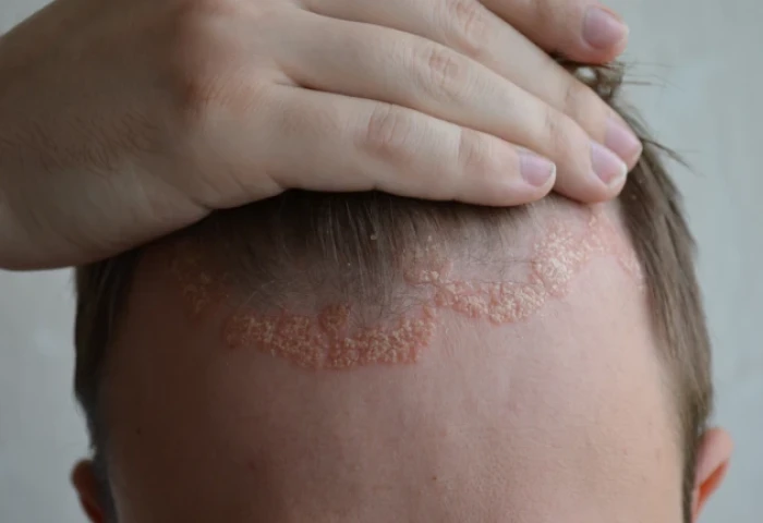 Ustequinumabe (Stelara®): O que é, para que serve e como obter?